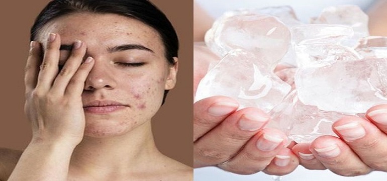 Benar Tidak Es Batu Bisa Menghilangkan Jerawat?